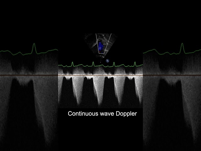 Understanding Dynamic and Fixed Obstruction in TOF #shorts #echocardiography #ultrasound #pediatrics