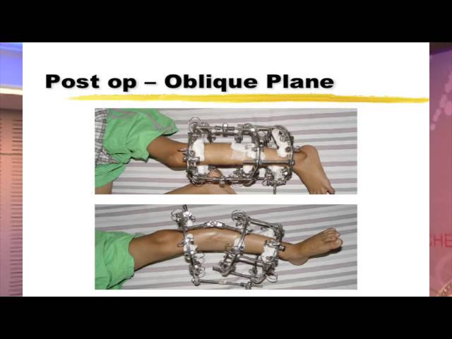 POSICON 2014 workshop on oblique plane deformity planning