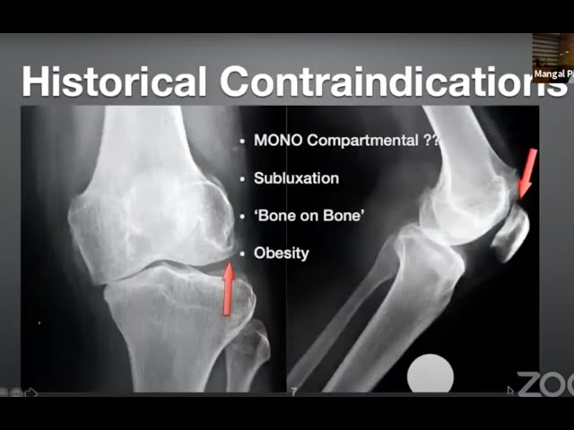 Knee Osteotomy for OA Knee What, when and How