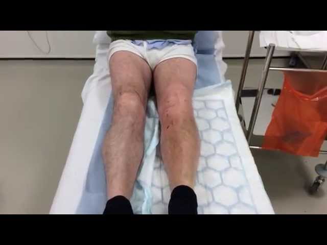 Patient interview at day 11 following HTO and precision bone wedge ( 30 3 15 )