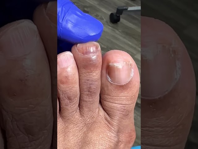 Subungal hematoma #podiatry #subungualhematoma #shoesize