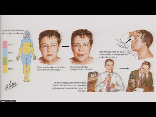 New and Emerging Treatments for Myasthenia Gravis