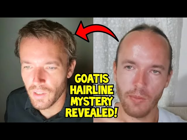 Sv3rige: The Mystery of Goatis’s Hairline Revealed!