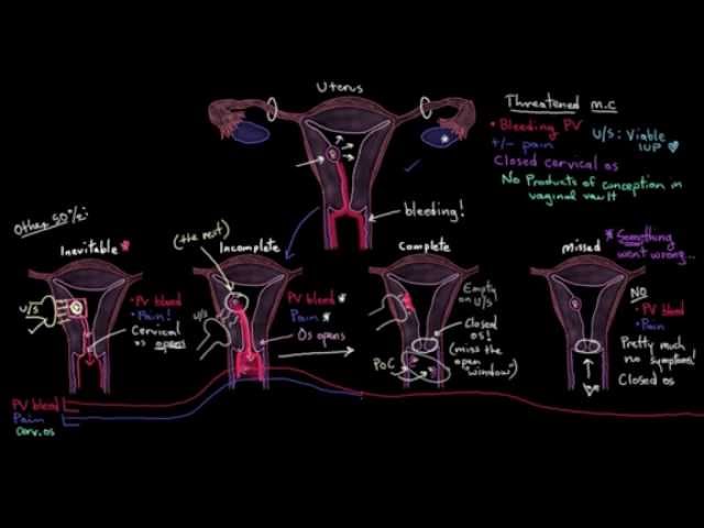 Miscarriage Basics and Types