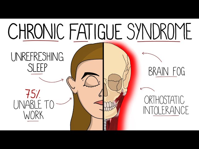 Myalgic Encephalomyelitis (Chronic Fatigue Syndrome) | Includes Criteria & Treatment