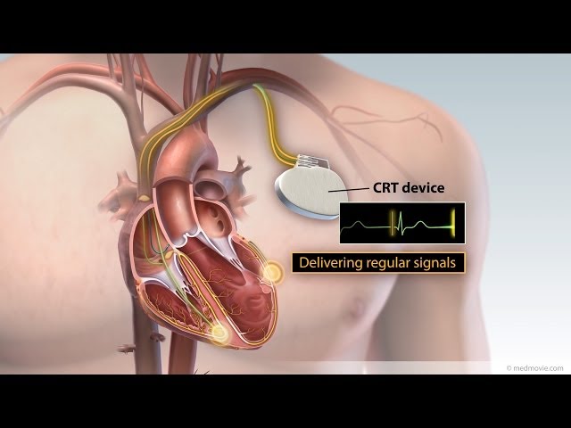 Cardiac Resynchronization Therapy