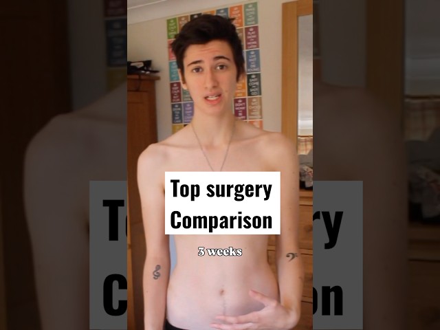 Trans guy top surgery comparison