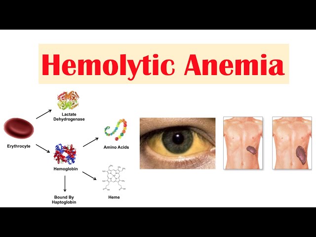 Hemolytic Anemia