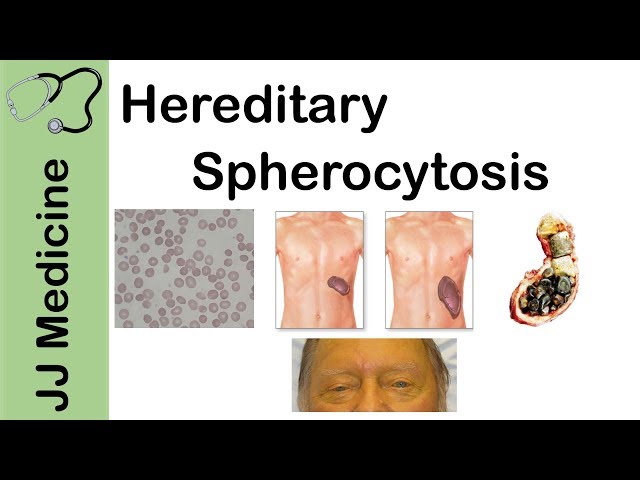 Hereditary Spherocytosis | Pathophysiology, Symptoms, Diagnosis and Treatment