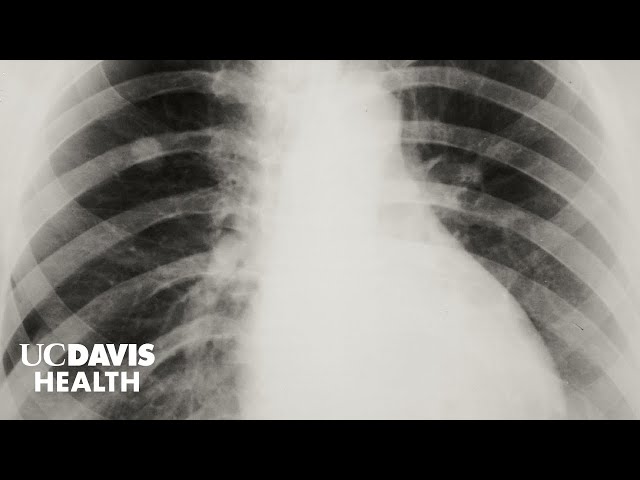 Lung Cancer in Asian American Women Who Never Smoked - The FANS Study at UC Davis