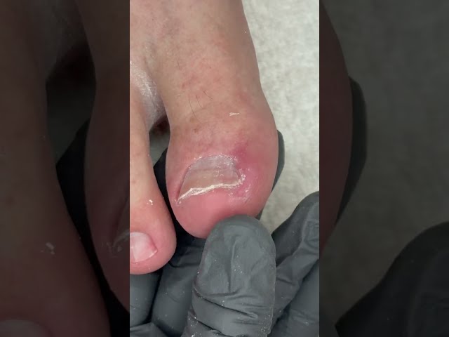 Satisfying Pedicure Process for Trapezoid Toenail🫠