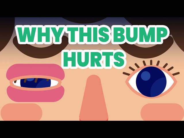 Blinking With Stye