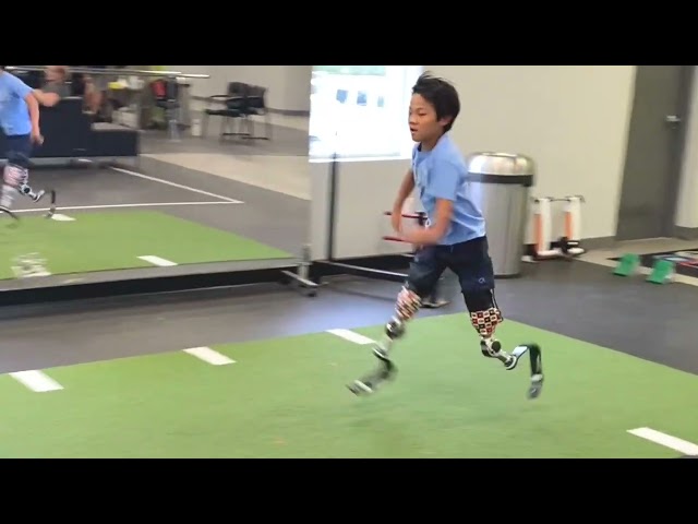 Charlie, Bilateral Above Knee Amputee - Running Knees and Blades