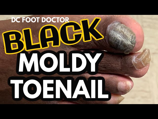 Black Mold located under Fungal Toenail: Black Moldy Toenail: