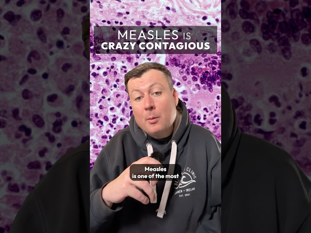 Measles is insanely contagious