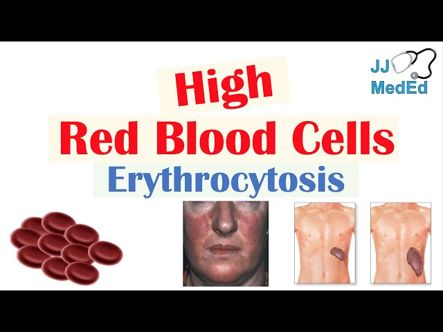High Red Blood Cells (Erythrocytosis) | Causes, Signs and Symptoms, and Treatment