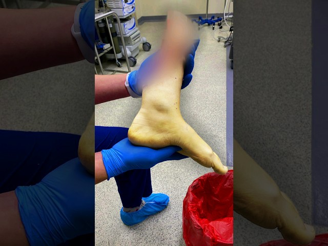 Three Years Post-Ampuation #ampuversary #amputee #amputeewoman #amputation