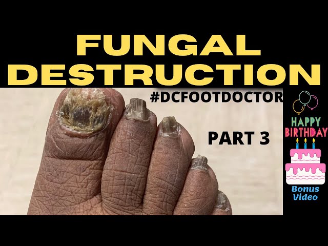 Severe Toenail Fungus: Still Making Progress (Birthday Bonus Video!)