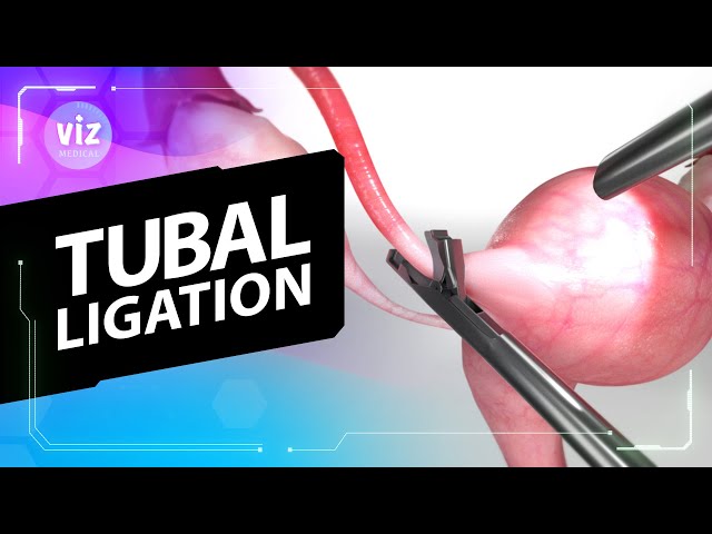 3 techniques for permanent birth control (3D Animation)