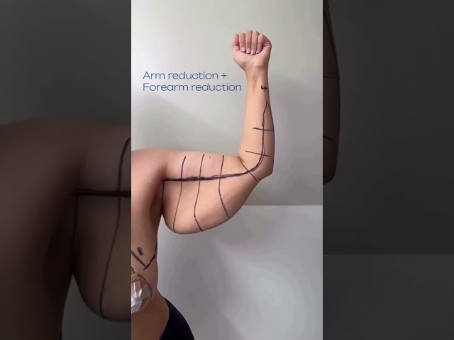 Arm and Forearm Reduction (Graphic Surgery Footage)