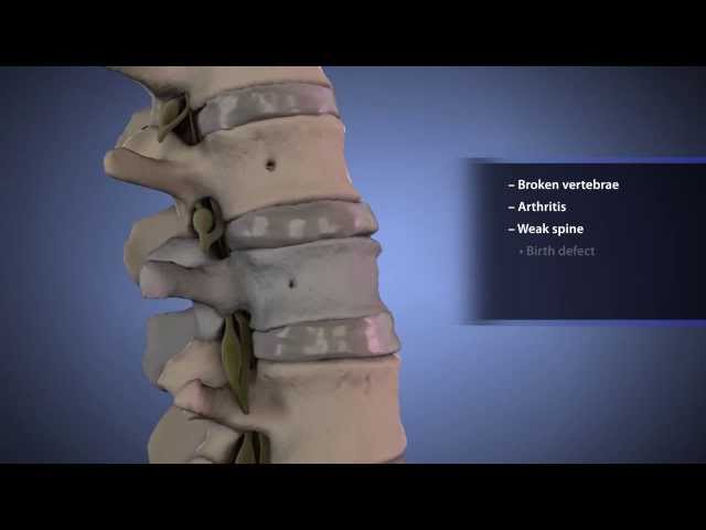 Spinal Instrumentation