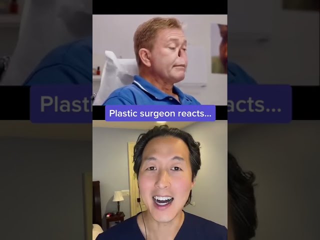 Amazing Nose Reconstruction with Prosthetic #shorts #nosereconstruction