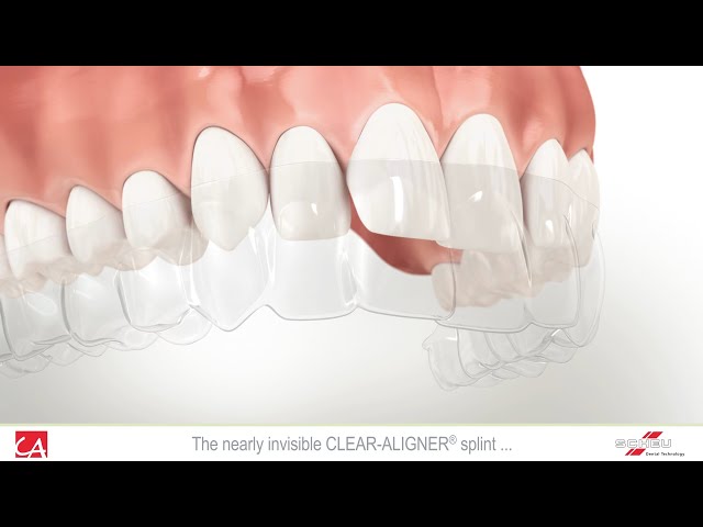 Treatment of Malocclusion Teeth with Invisible Splint