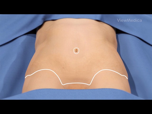 Tummy Tuck (3D Animation)