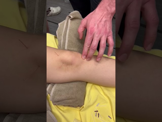 How to Treat Knee Pain with Dry Needling | IAOMM Course UK