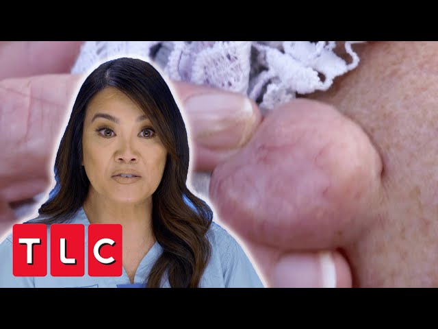 Dr Lee Removes A Bump She Named “Big Mama”! | Dr Pimple Popper Pop Up