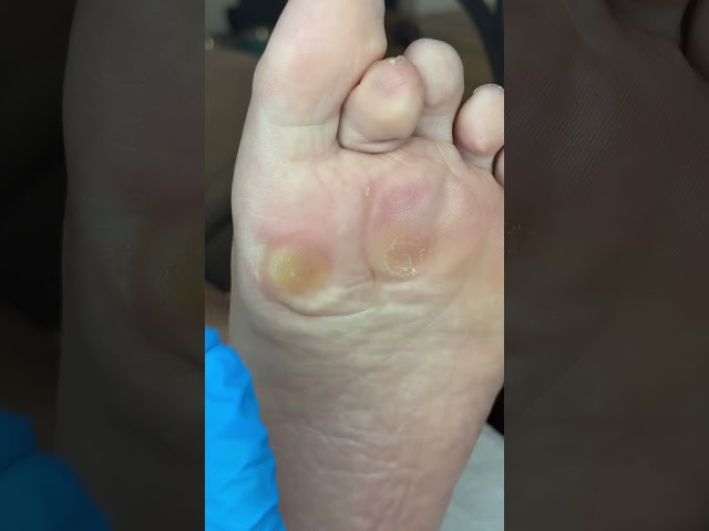 Huge Calluses Removal🔥