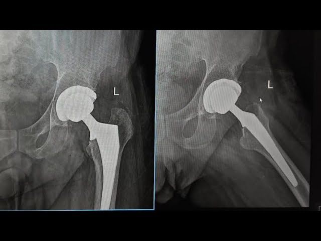 Life After Hip Replacement-Top 5 Most Commonly Asked Questions PART 2 