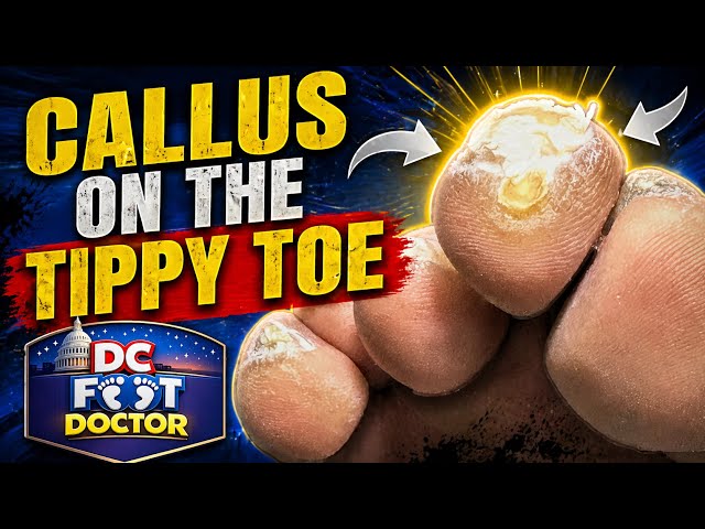 Callus On The Tippy Toe