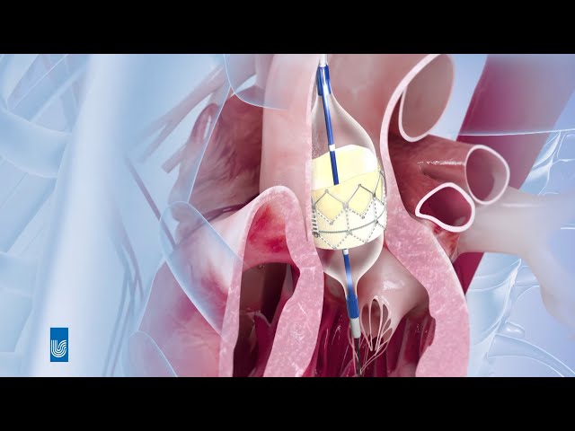 TAVI bei Aortenklappenstenose | Medizin Animation
