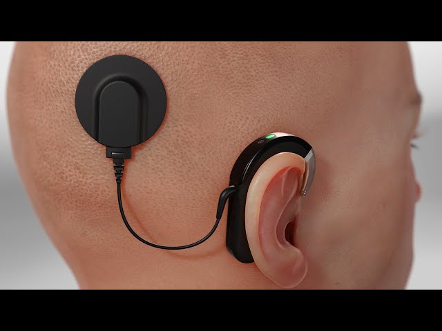 Cochlear Implant (3D Animation)