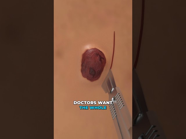 Skin Biopsy Explained: What Happens to That Tiny Sample?