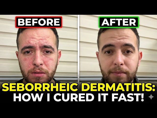 Seborrheic Dermatitis Face Treatment: How I Cured Redness & Flakes Fast (2026)