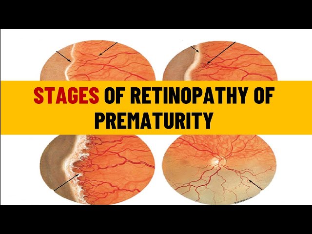 Retinopathy of prematurity Staging