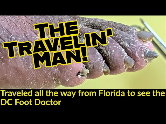 The Travelin' Man: Trimming Fungal Toenails and Athlete's Foot. He Traveled Far To Visit Me (Part 1)