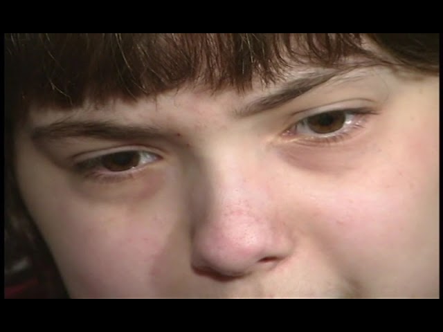 Cranial Nerve Exam: Abnormal Examples