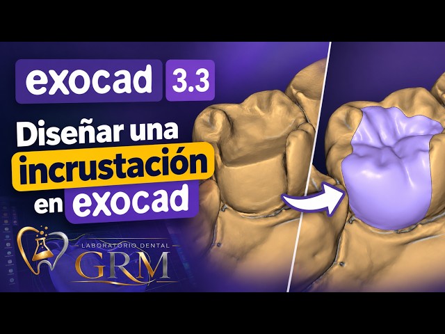 Cómo Diseñar una Incrustación InlayOnlay en Exocad 3 3  Tutorial Paso a Paso