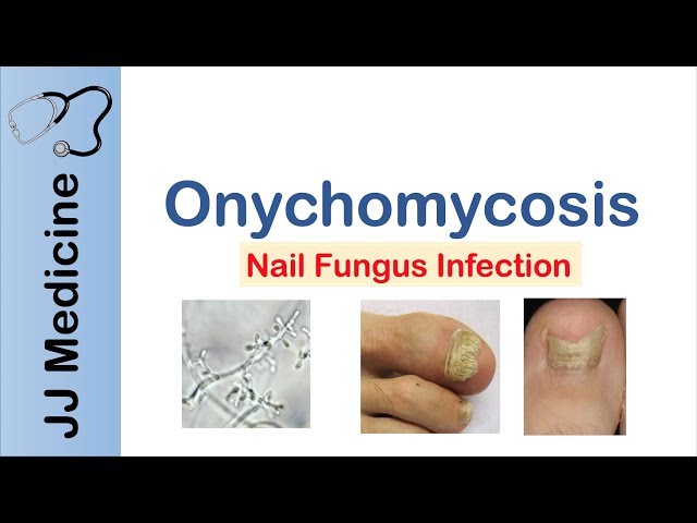 Onychomycosis | Nail Infection | Signs, Symptoms, Treatment