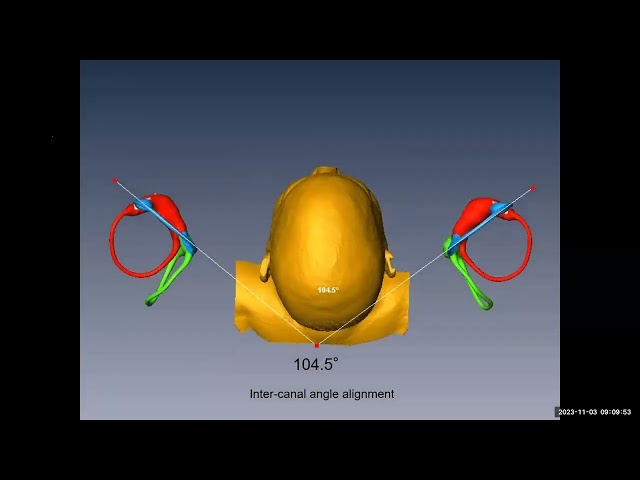 A Comprehensive Review of BPPV Diagnosis and Treatment