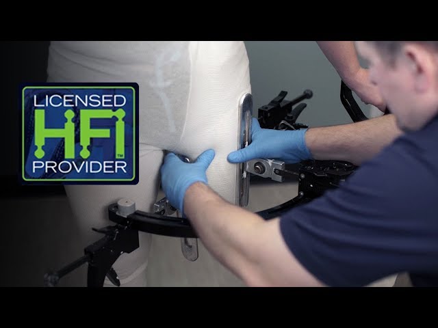 HiFi Socket Interface Casting -  Cornerstone Prosthetics