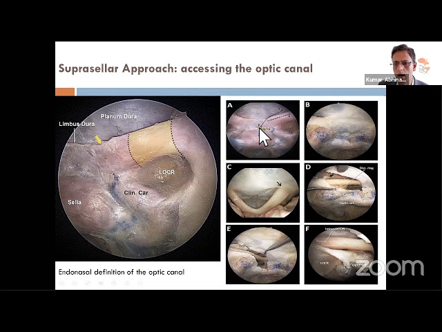 Surgical Anatomy for Endonasal Skull Base Approaches- Kumar Abhinav