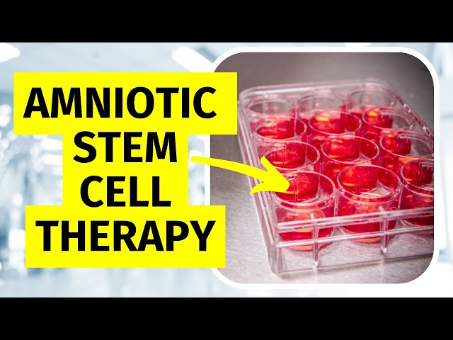 Amniotic Stem Cell Therapy for Knee Arthritis