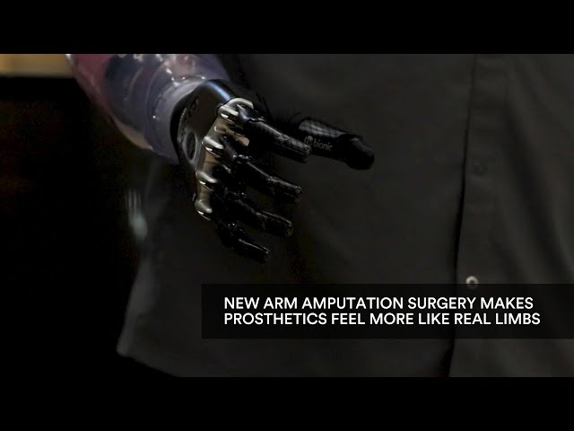 New arm amputation surgery makes prosthetics feel more like real limbs
