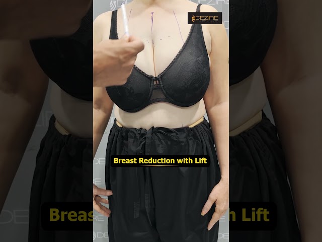 Breast Reduction & Lift Marking