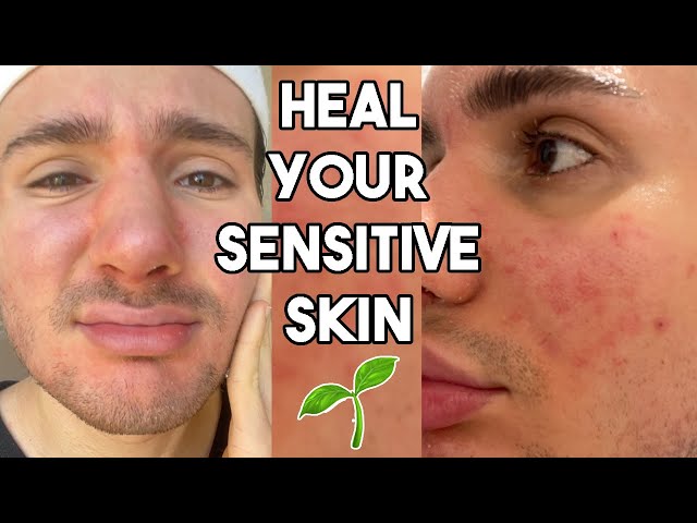 How to Soothe Sensitive Skin! |💥 | Skincare Routine for Irritated Skin