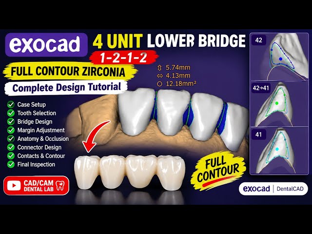 Exocad 4-Unit Lower Zirconia Full Contour Bridge | Complete Design Tutorial #exocad